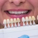 Smile Bright: Exploring Affordable Excellence with Dental Veneers in Colombia